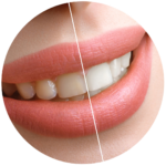Comparación de dientes antes y después de un tratamiento de blanqueamiento dental en Serviprodent, Valdemorillo