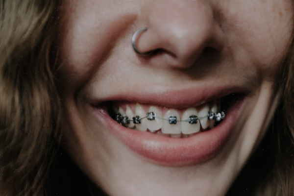 Ortodoncia Tradicional: Eficacia Probada nrisa de una persona con brackets metálicos tradicionales